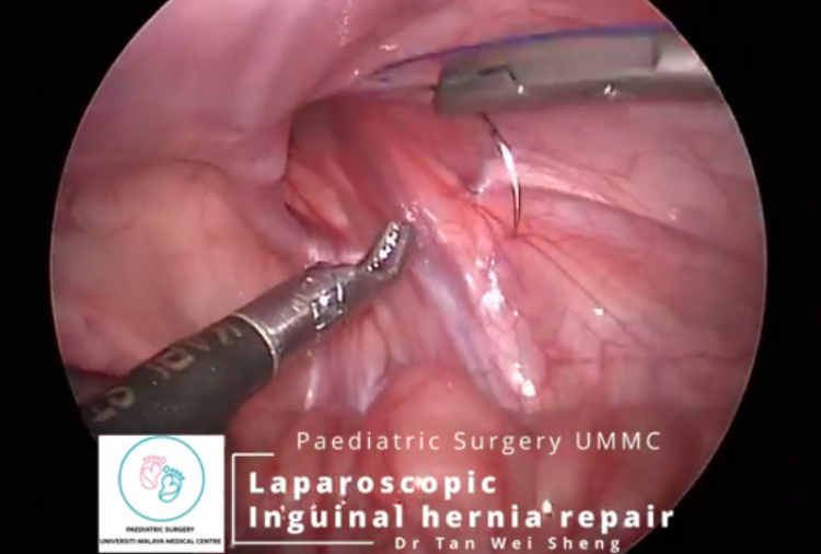 Paediatric Laparoscopic Hernia Repair